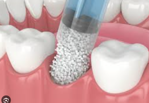 Precision Bone Graft Powder, 500-1000 Micron, 1cc - Optimal Particle Size for Dental & Orthopedic Regeneration